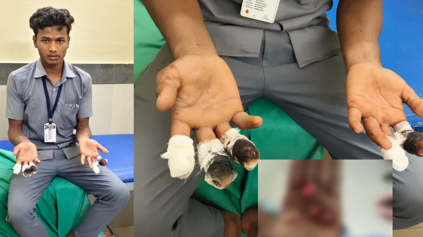 बड़ी लापरवाही: डौंडीलोहारा ITI में मरम्मत कार्य के दौरान हादसा, छात्र के दोनों हाथों की 5 उंगलियां कटी बड़ी लापरवाही: डौंडीलोहारा ITI में मरम्मत कार्य के दौरान हादसा, छात्र के दोनों हाथों की 5 उंगलियां कटी